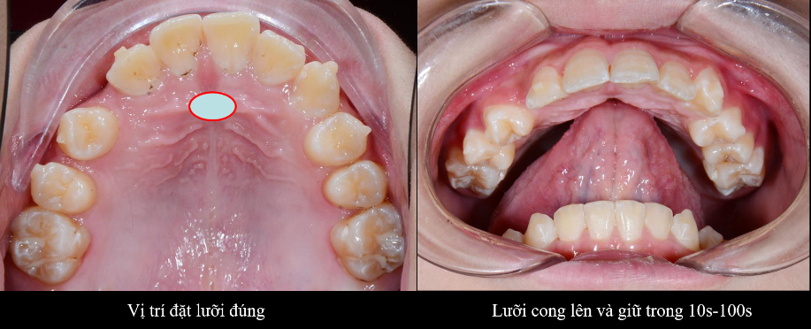 ĐIỀU TRỊ LOẠI BỎ THÓI QUEN XẤU ĐẨY LƯỠI – Nha Khoa Như Ngọc