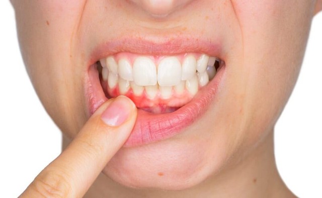 Phòng tránh viêm quanh răng thế nào? - Ảnh 2.