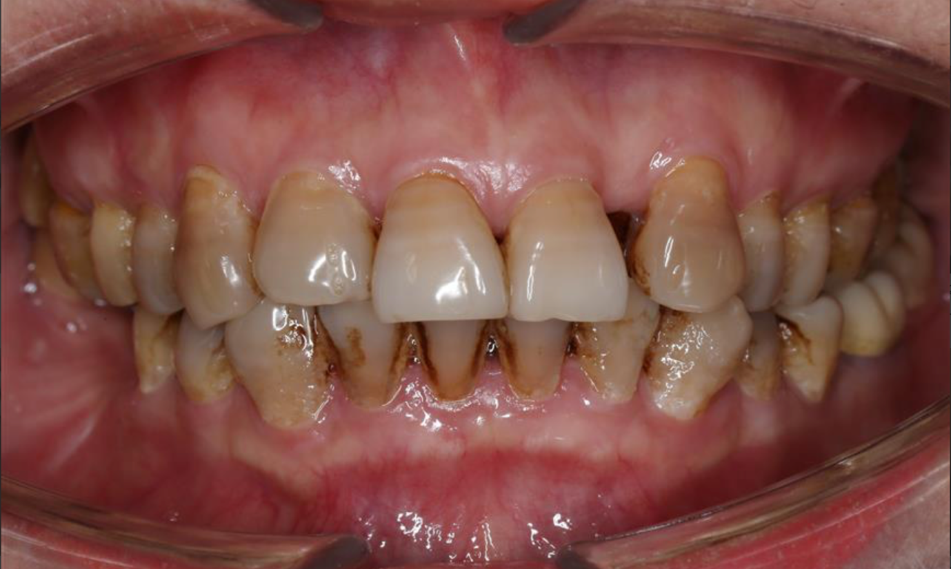Răng xỉn màu làm cách nào để trắng sáng?- Ảnh 1.