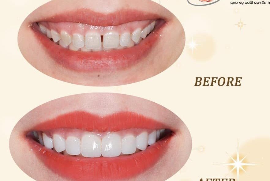 Gắn cố định và hướng dẫn chăm sóc