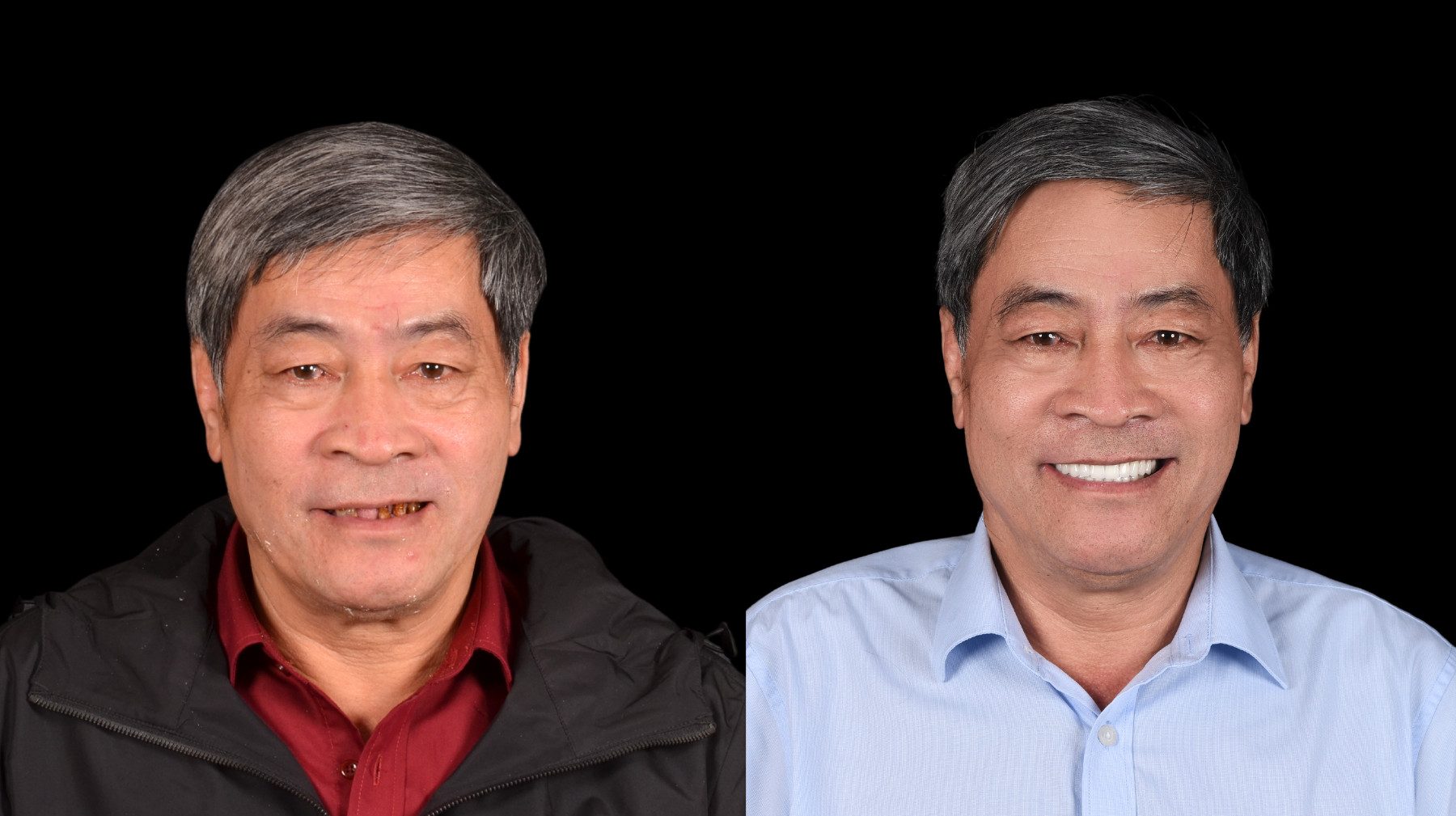 Lắp răng sứ và kiểm tra khớp cắn