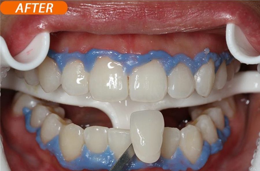 Thiết kế và chế tác phục hình