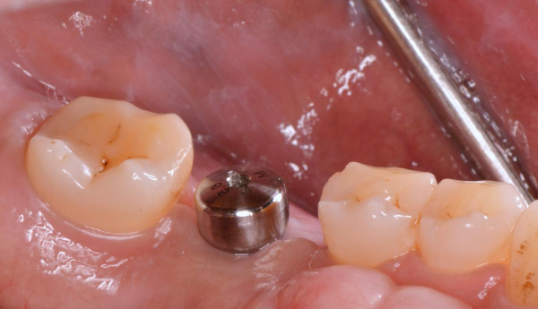 Gắn trụ lành thương và lấy dấu răng