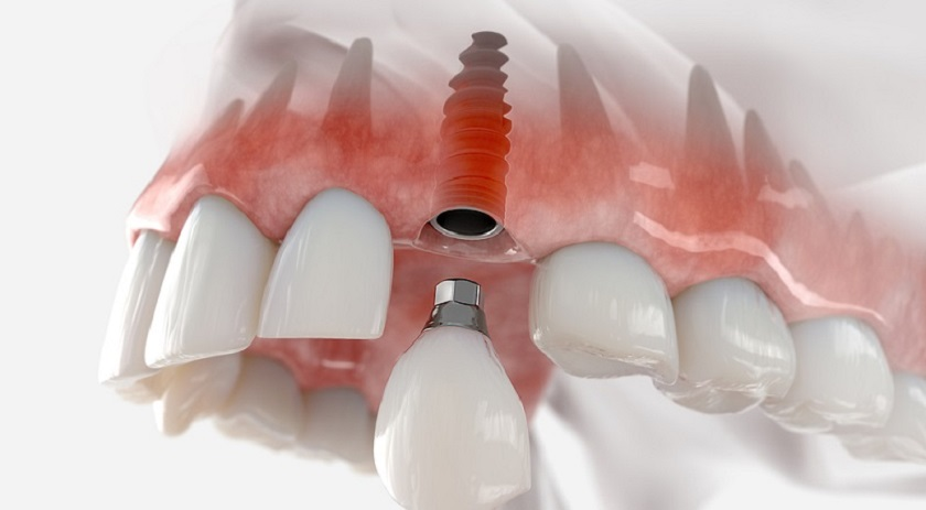 Giai đoạn lành thương và tích hợp xương