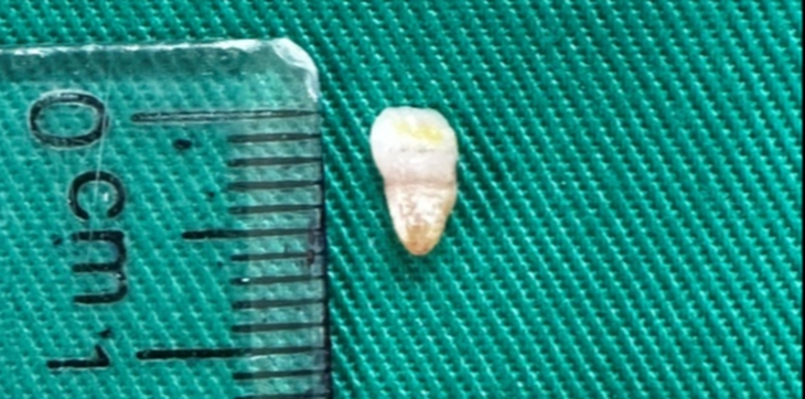 Trẻ sơ sinh có răng mọc ngay lúc sinh, hiện tượng hiếm gặp hay kỳ lạ? - Ảnh 1.