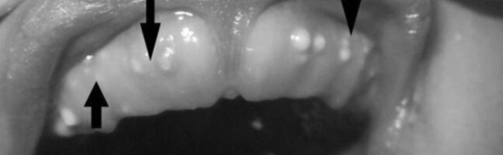 Con bạn có nanh sữa khi vừa sinh, có cần điều trị sớm? - Ảnh 3.