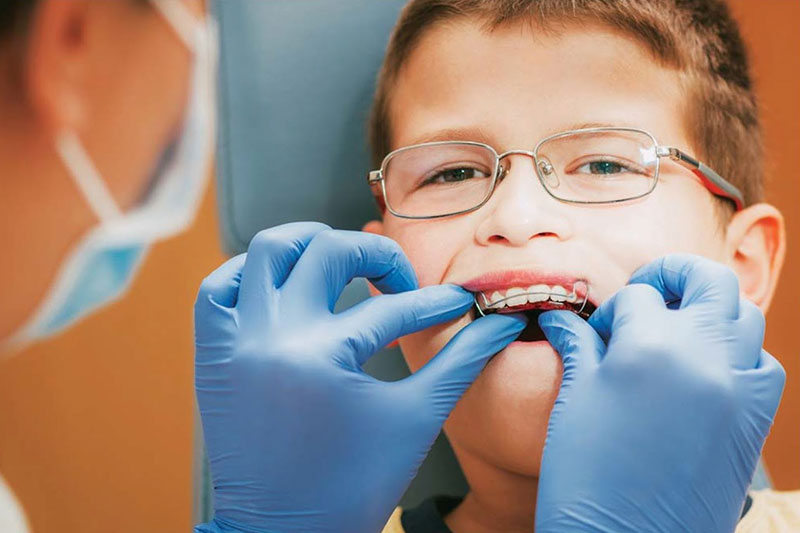 Khi nào có thể bắt đầu chỉnh nha cho trẻ em?- Ảnh 2. Khi nào có thể bắt đầu chỉnh nha cho trẻ em?- Ảnh 2.