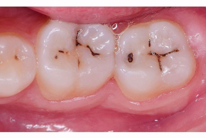 Vết đen trên răng hàm là gì? Điều trị như thế nào?