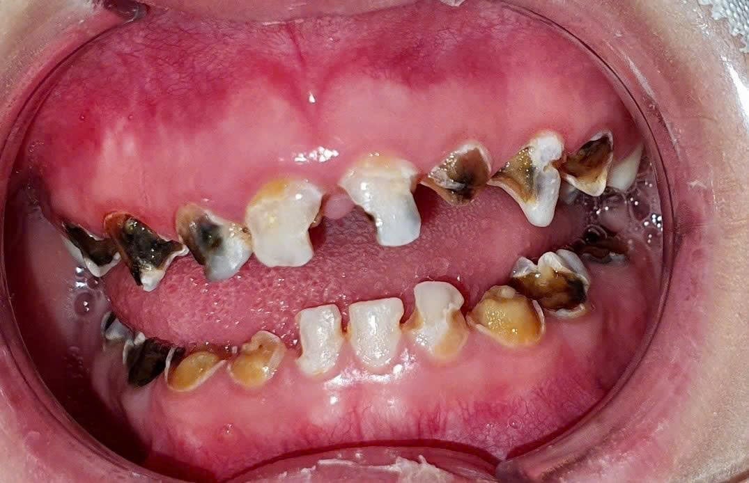 Bệnh nhân bị sâu răng cả hai hàm do vệ sinh răng miệng kém và không được điều trị sớm kịp thời. Ảnh: GS.TS. Võ Trương Như Ngọc.