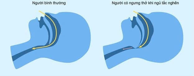 Hình minh họa đường hô hấp trên ở người khỏe mạnh và người có ngưng thở khi ngủ tắc nghẽn (OSA). Ảnh: Như Ngọc.