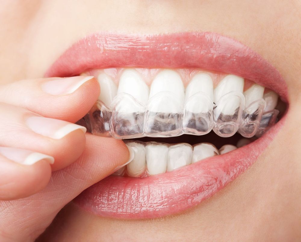 Niềng răng trong suốt invisalign và những điều cần biết | Vinmec