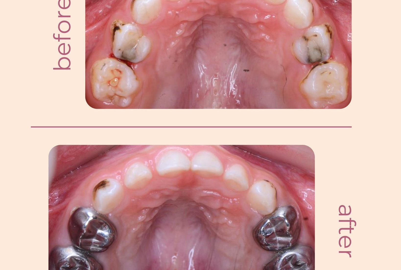 Dental restoration and shaping
