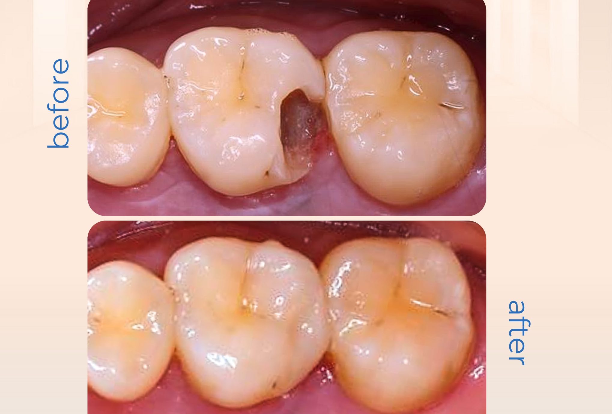 Restoring the aesthetics and function of teeth.