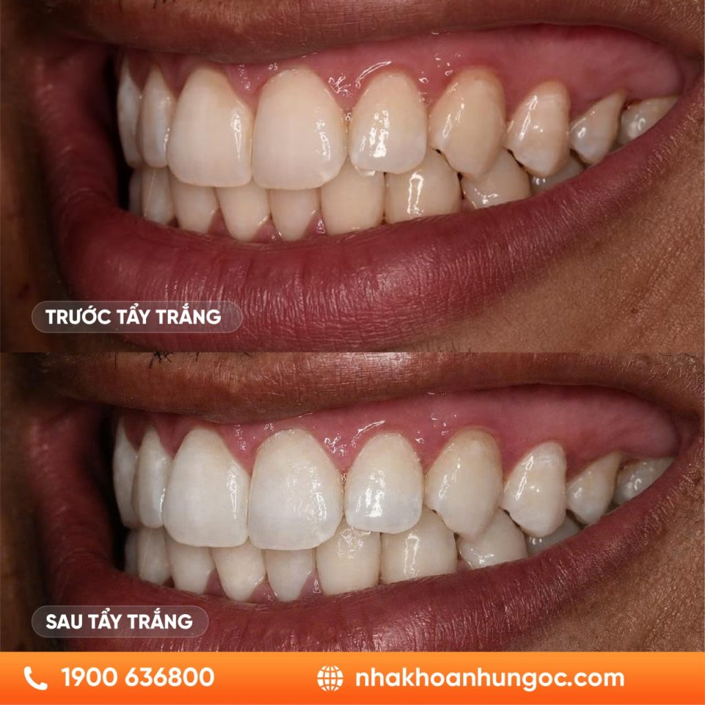Hình trước và sau tẩy trắng răng tại Nha khoa Như Ngọc