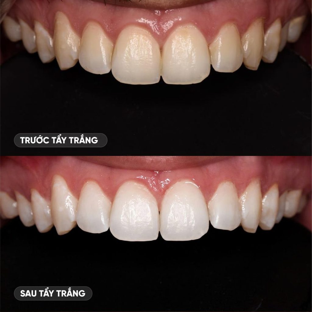 Hình trước và sau tẩy trắng răng tại Nha khoa Như Ngọc 