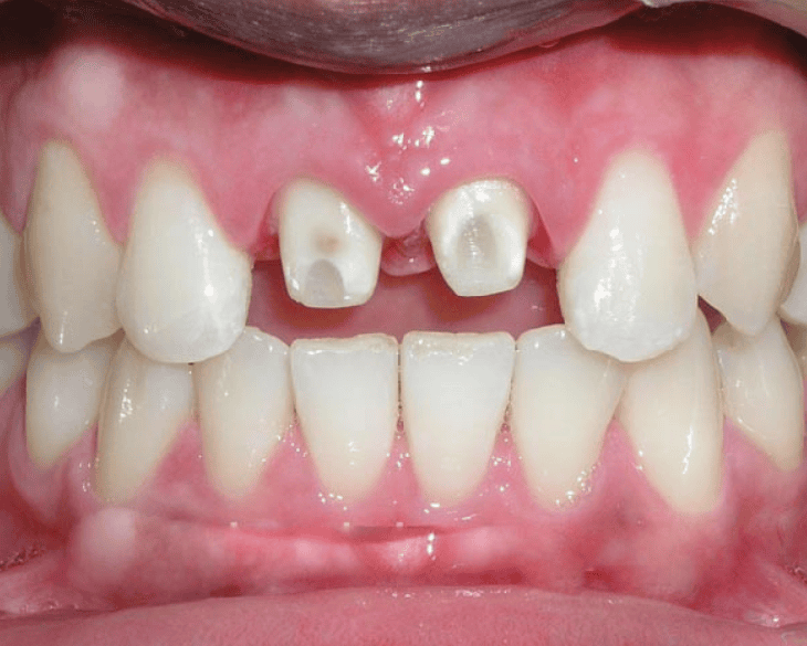 Trước khi mài răng để bọc sứ, đừng quên 4 câu hỏi này- Ảnh 1.